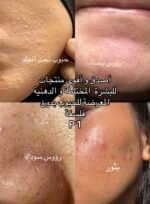 ⁦روتين 3W Clinic للعناية بالحبوب وآثارها - 4 منتجات⁩ - الصورة ⁦2⁩
